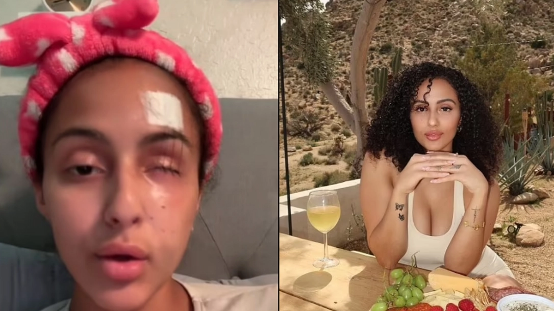 Woman explains what happened after losing her eye during ‘traumatic’ freak accident while walking dog