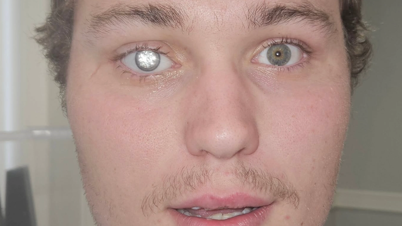 Man explains why he got $2million diamond embedded into his eye as shocked people say he looks like 'Bond villain'