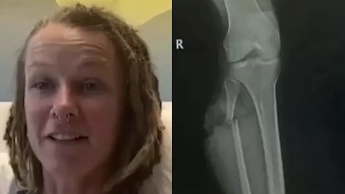 Woman feels lucky to be alive after a dip in her local river ended in brutal alligator attack