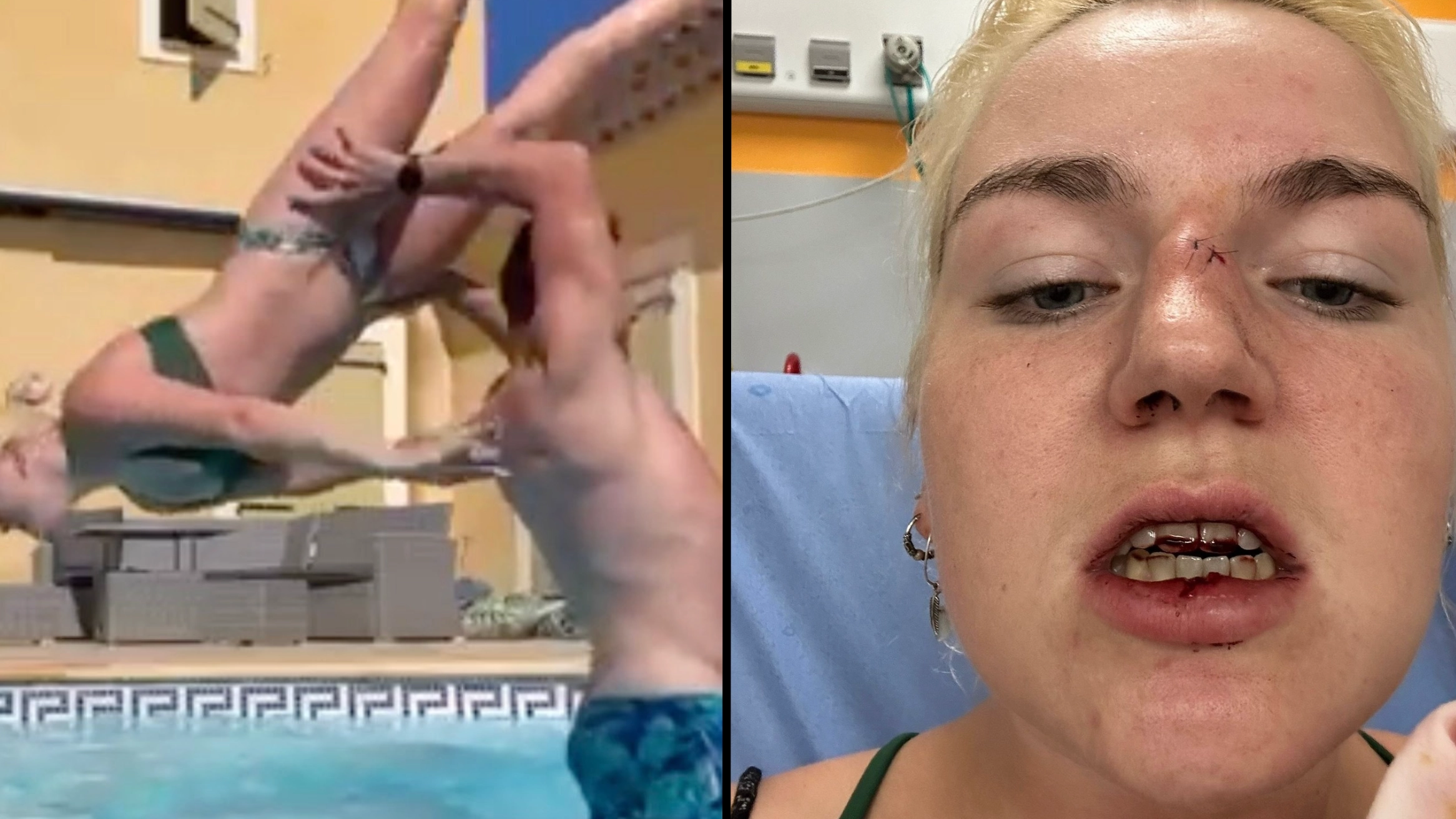 Woman tries Dirty Dancing lift with boyfriend and ends up smashing two front teeth and breaking nose