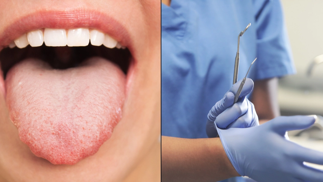 Dentist's warning over poor diet choice that can lead to a 'black hairy tongue'