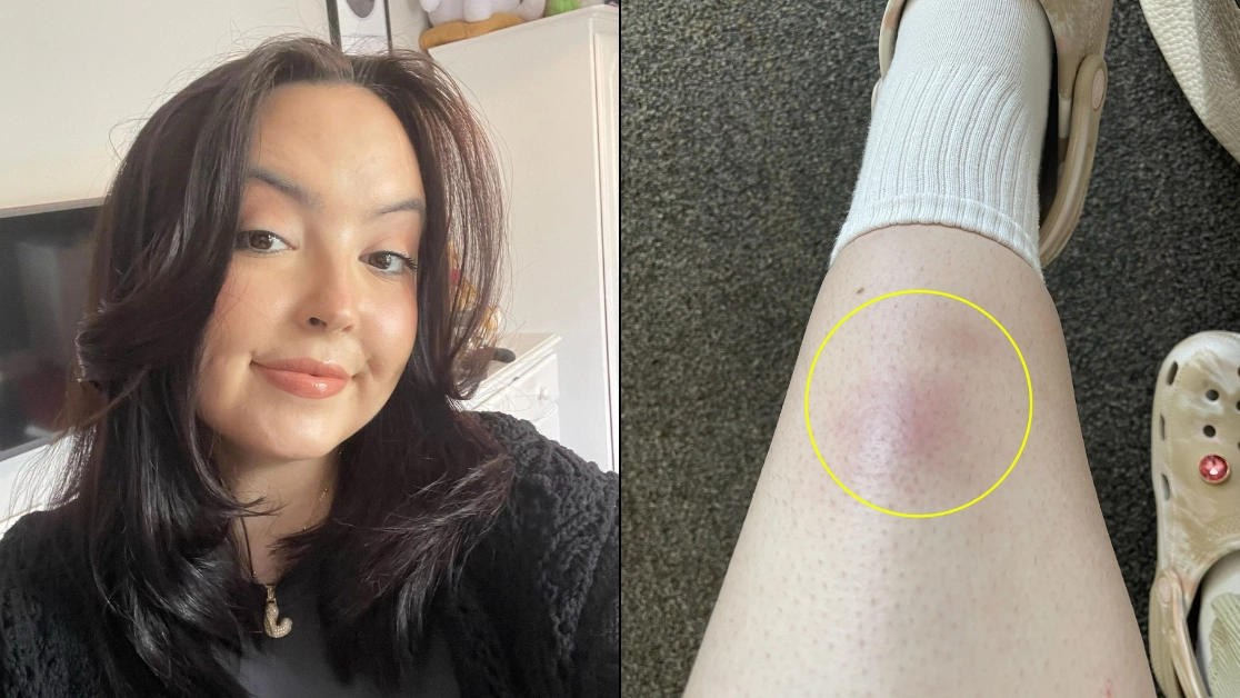 Woman had bizarre cancer warning sign on her leg before being told she had tumour ‘crushing’ her heart
