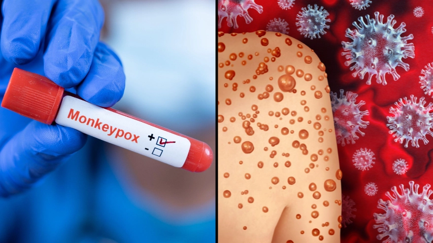 World Health Organization Is Renaming Monkeypox Over Fears It's 'Discriminatory'