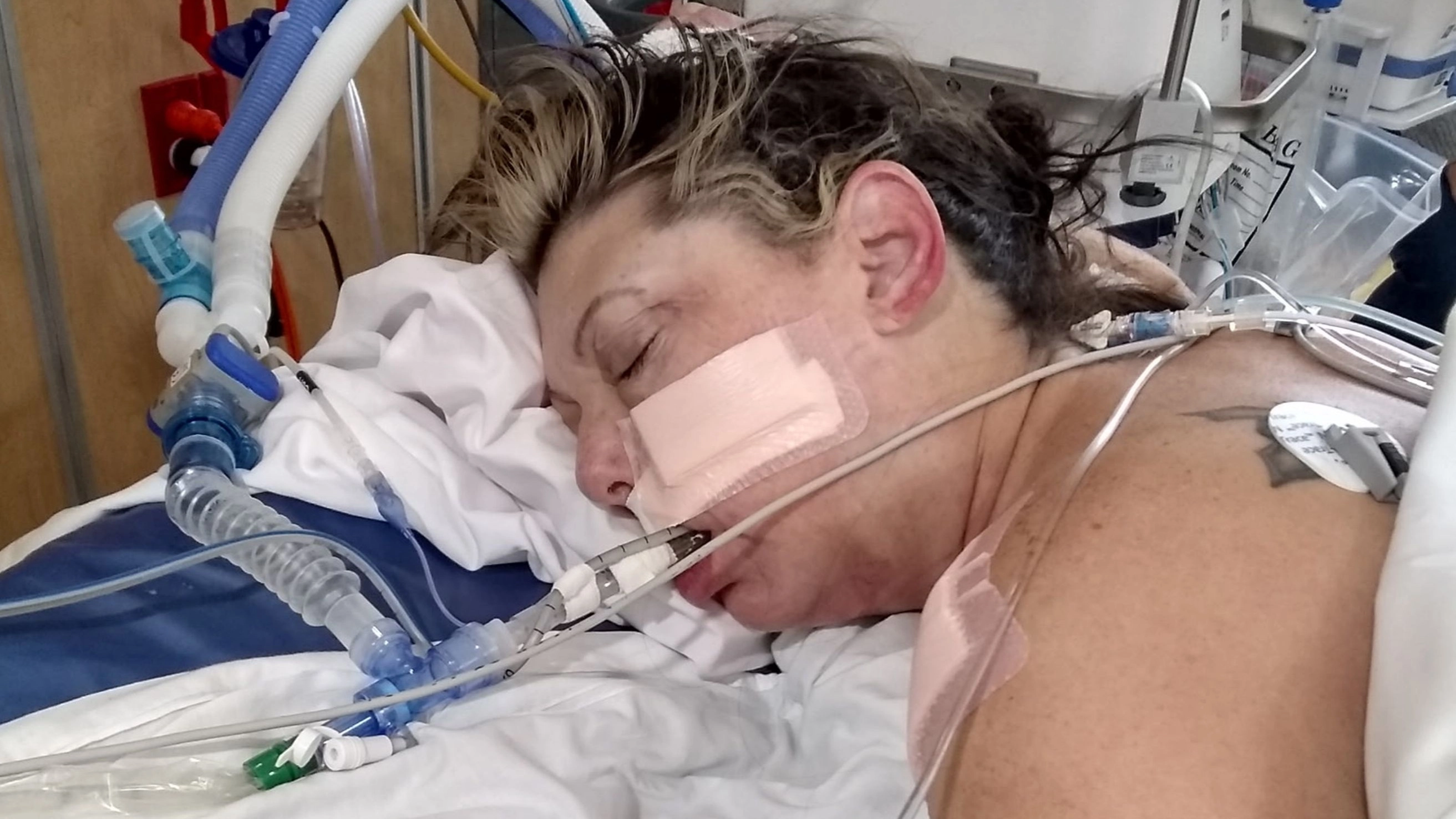 Woman who vaped whilst ill left in coma with 'crispy lungs'