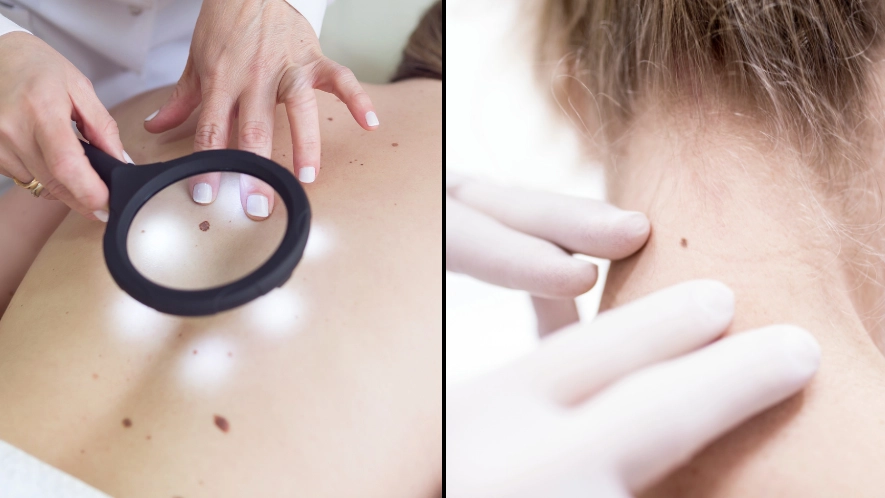 Doctor shares five main 'red flag' signs to look out for that could mean skin mole is cancerous