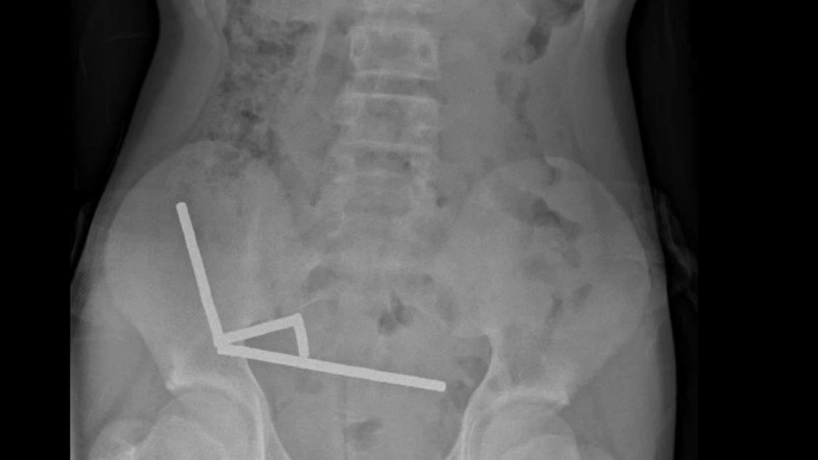 13-year-old boy has part of his intestines removed after swallowing 100 magnets