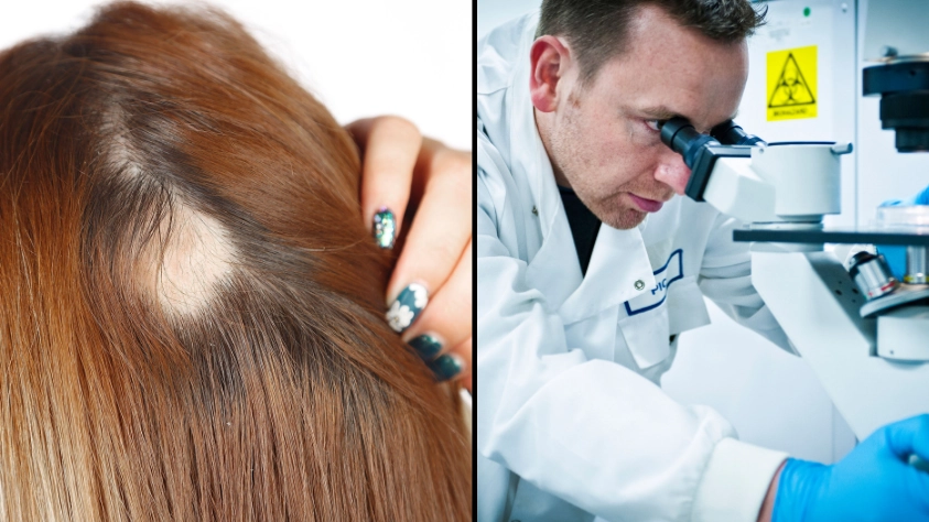 New Trials For Alopecia Treatment Are A Success, According To Study