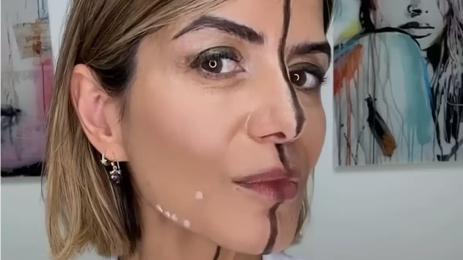 Woman injected only one half of her face with Botox to show what it actually does to skin