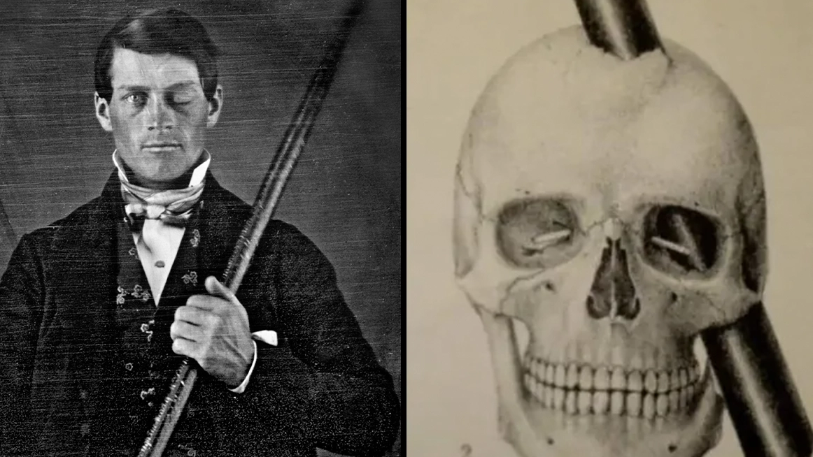Man survived traumatic injury when an iron rod shot through his brain