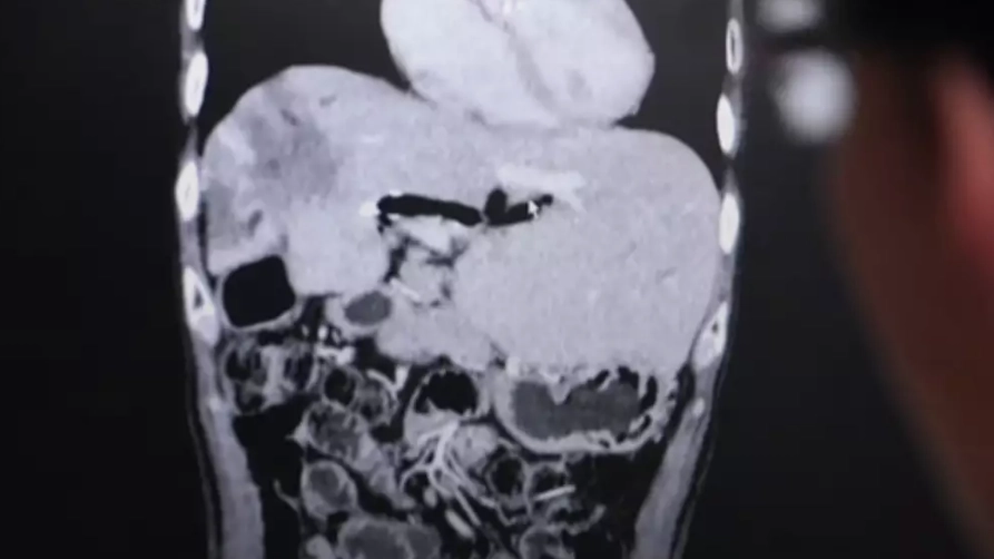 X-ray shows how single bite of Thai dish can give you liver cancer as residents respond to doctor's warning