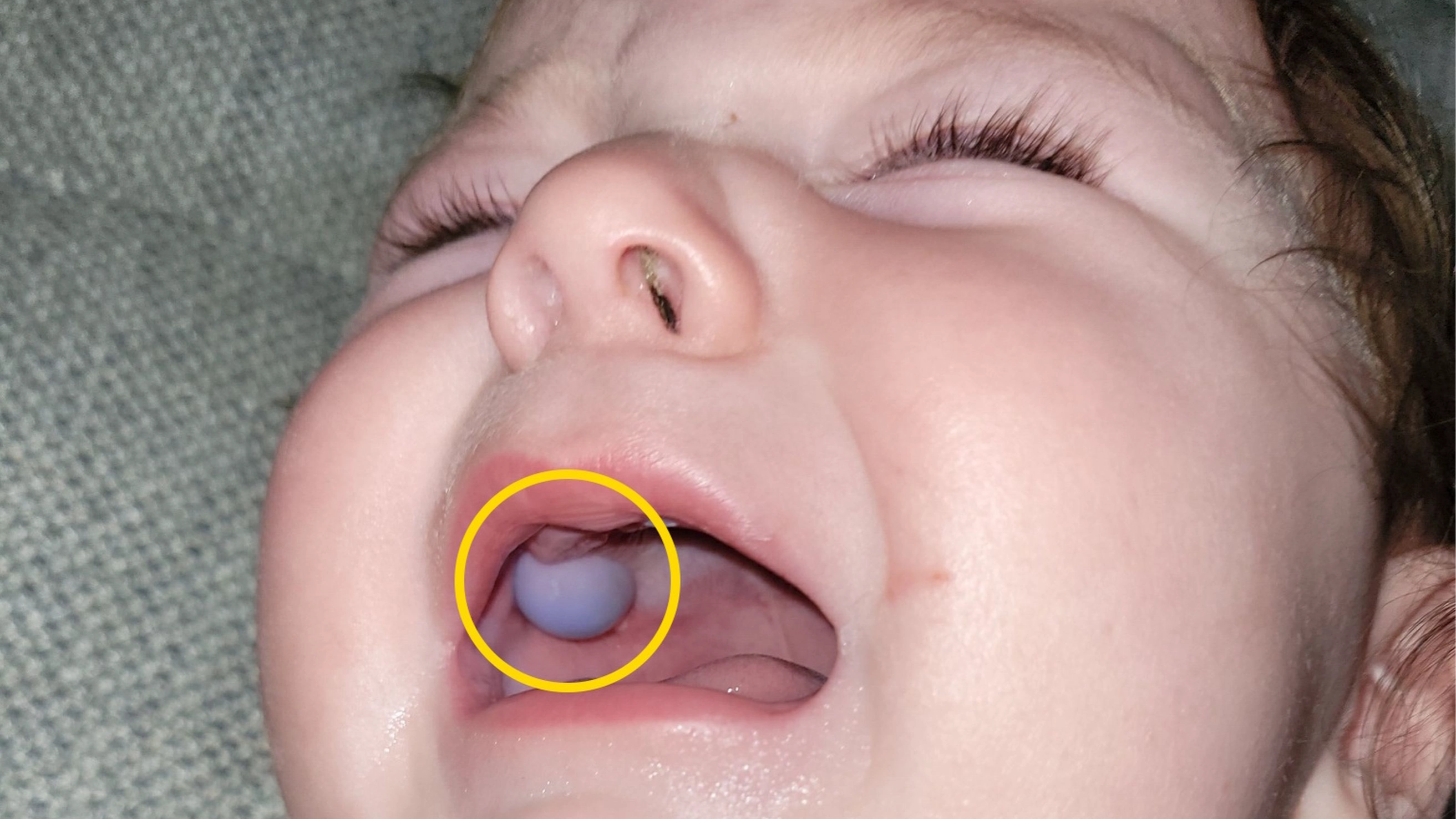 Stunned doctors thought baby had mouth tumour until discovering alarming truth