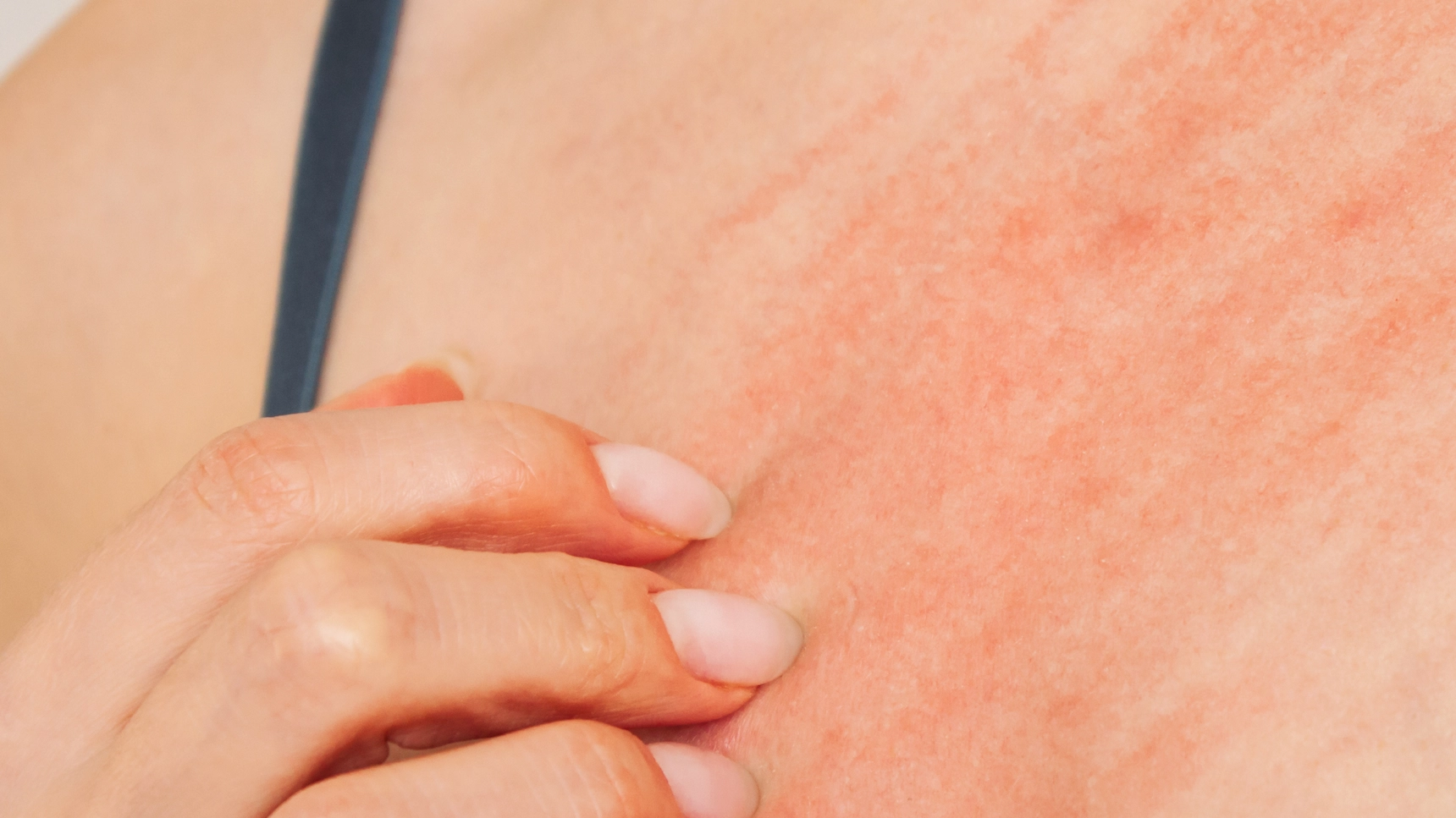Doctor issues severe warning after 'medieval' disease sweeping UK keeps getting misdiagnosed