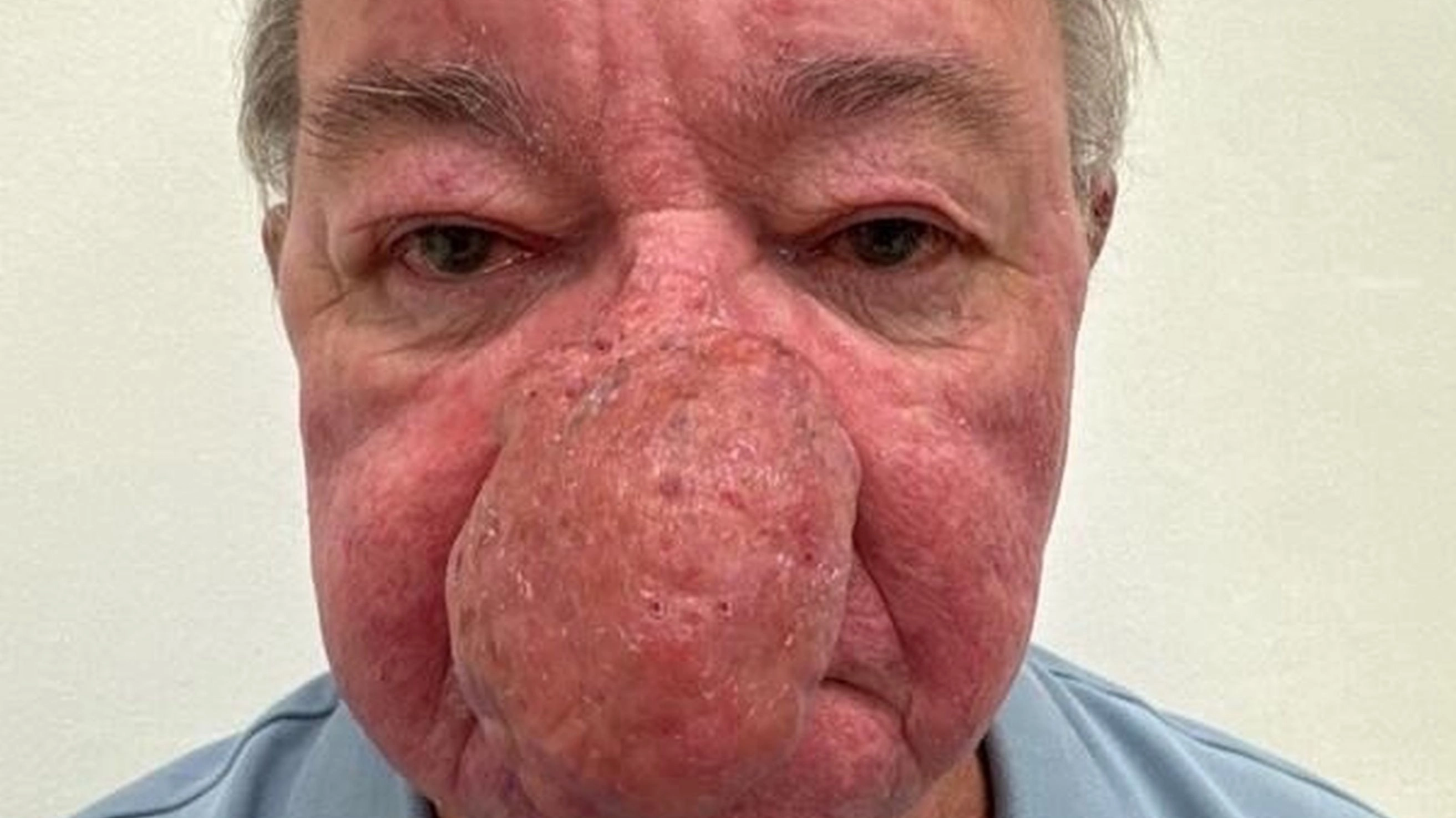 Grandad's heartbreaking statement after condition left his nose so big he couldn't kiss his wife