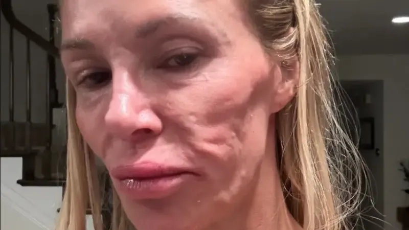 Model Brandi Glanville getting ‘face taken off’ after breast implants cause parasite