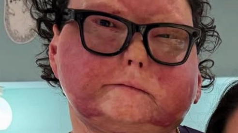 Man who had world's first successful face and double hand transplant shares images of before accident