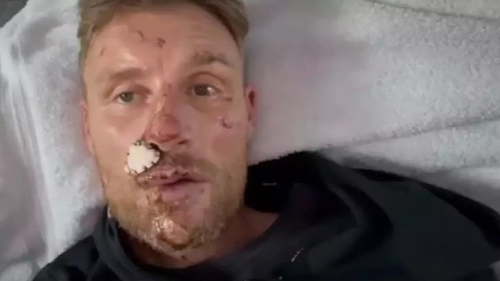 Shocking new photos show full extent of Freddie Flintoff's injuries after Top Gear crash where he 'wished he died'