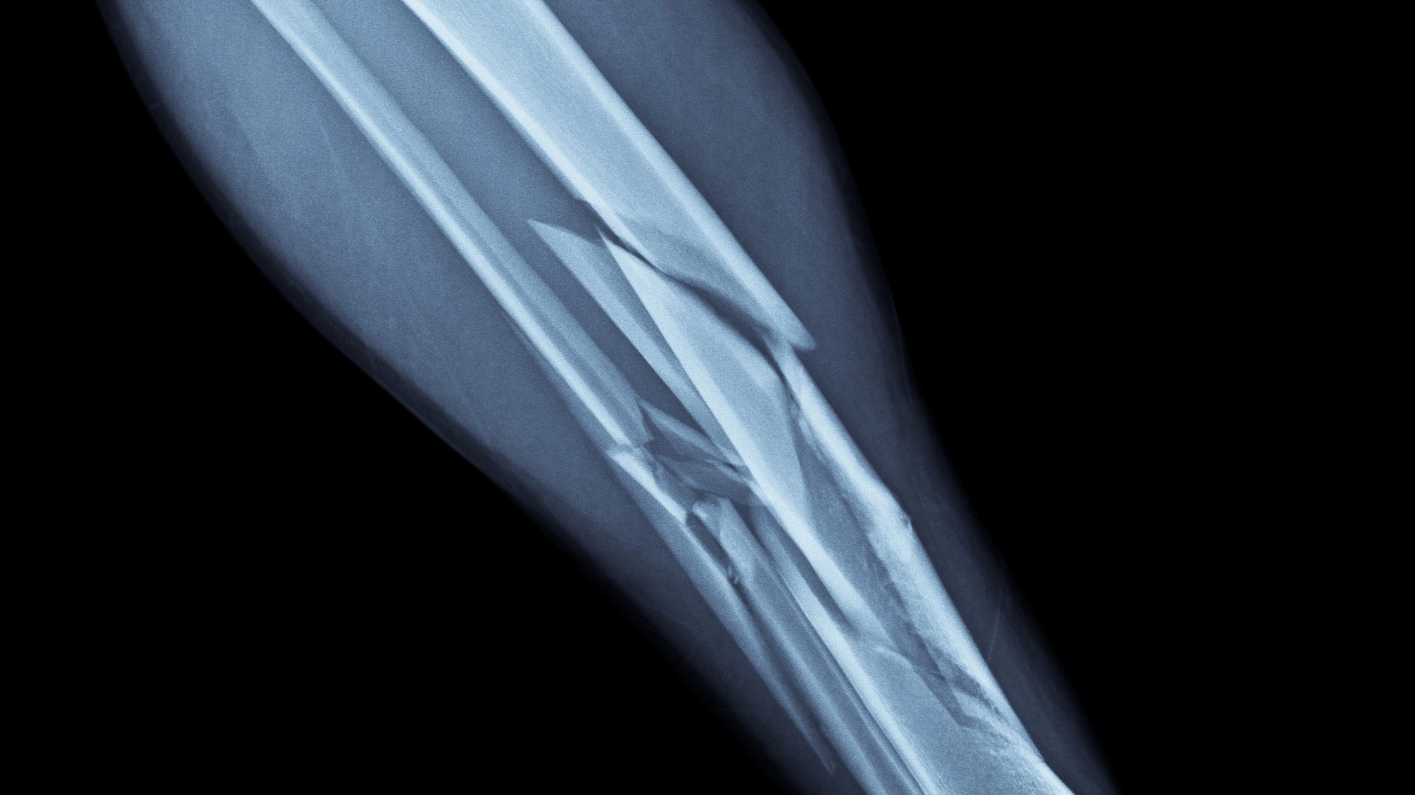 What happens if you break a bone as an adult vs as a kid as strange theory emerges
