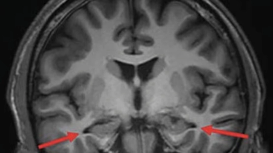 Brain scan of 'youngest ever' Alzheimer's patient shows devastating impact of disease