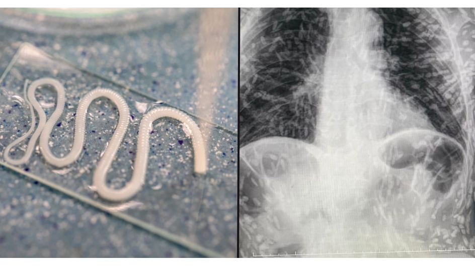Man who went to hospital with cough shocked to discover he’s swarming with tapeworms