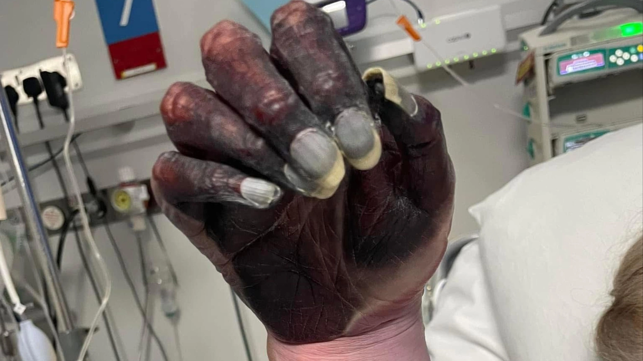 Mum forced to have arm amputated days after doctors 'mistook black hand for newspaper ink'