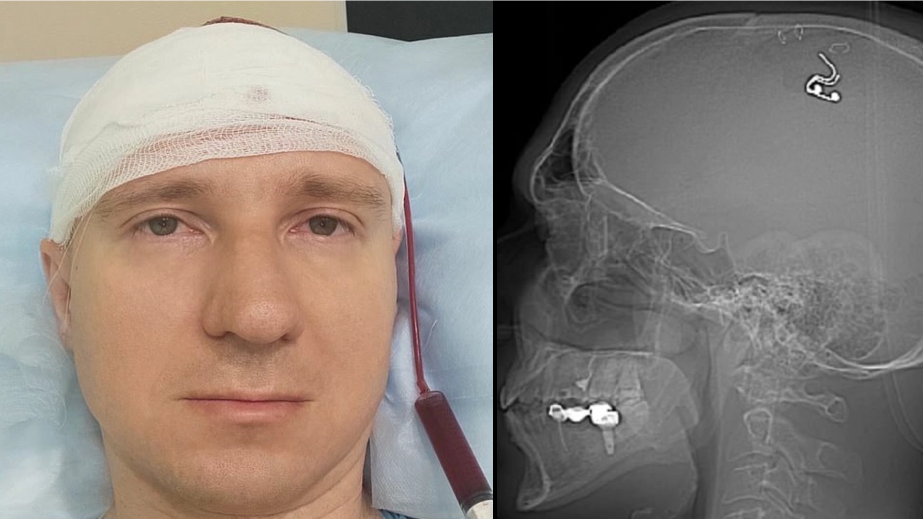 Researcher claims to have implanted chip into his brain which he hopes can control his dreams