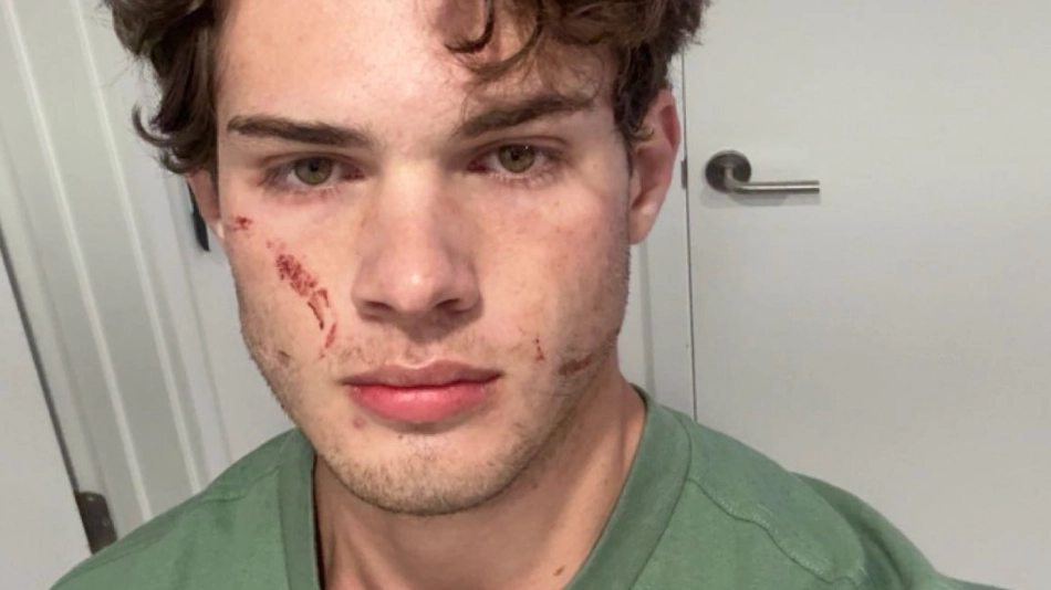 Clavicular explains why he took substances as 'Looksmaxxer' speaks out for first time since overdose