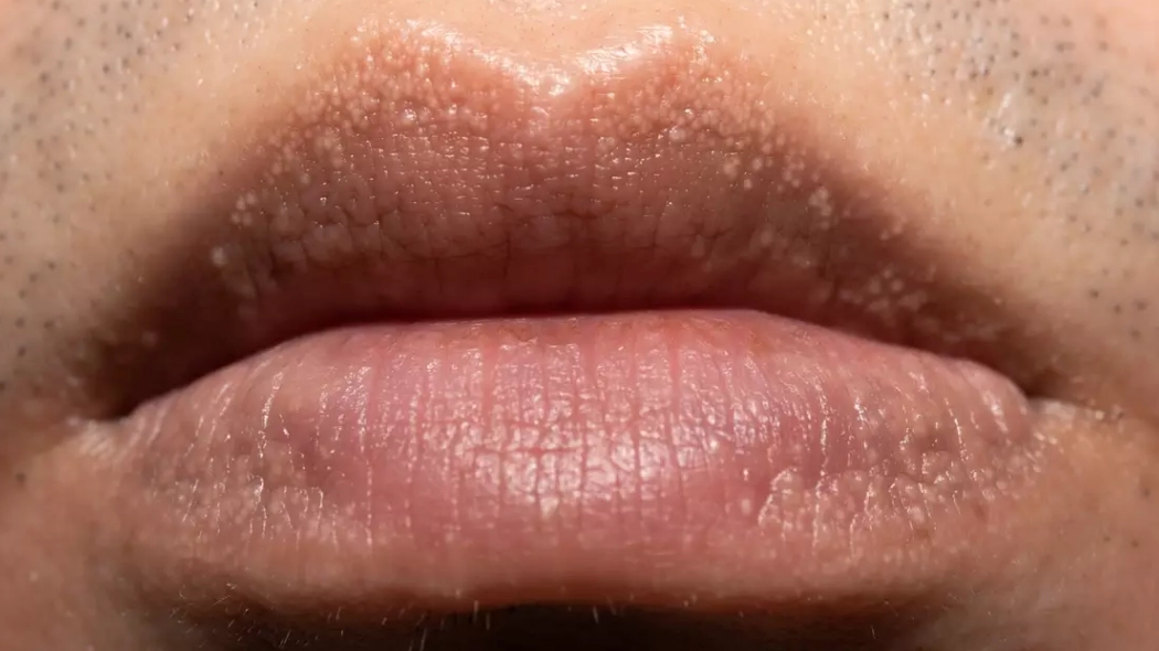 People commonly misidentify strange white bumps you can find on your body and private parts