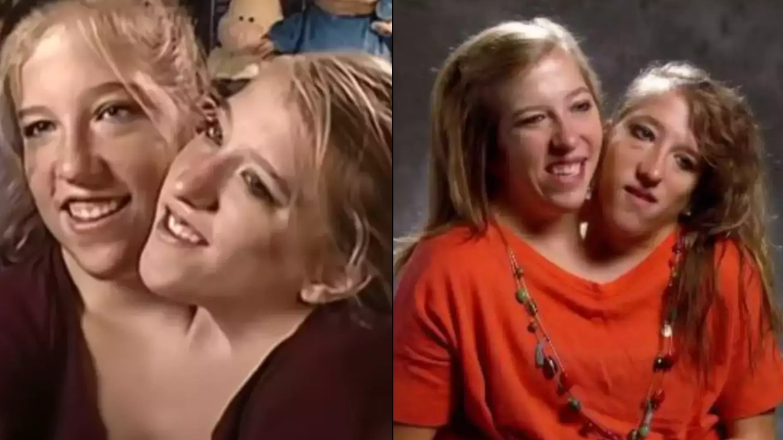 Conjoined twins Abby and Brittany Hensel confirm how their bodies are really connected
