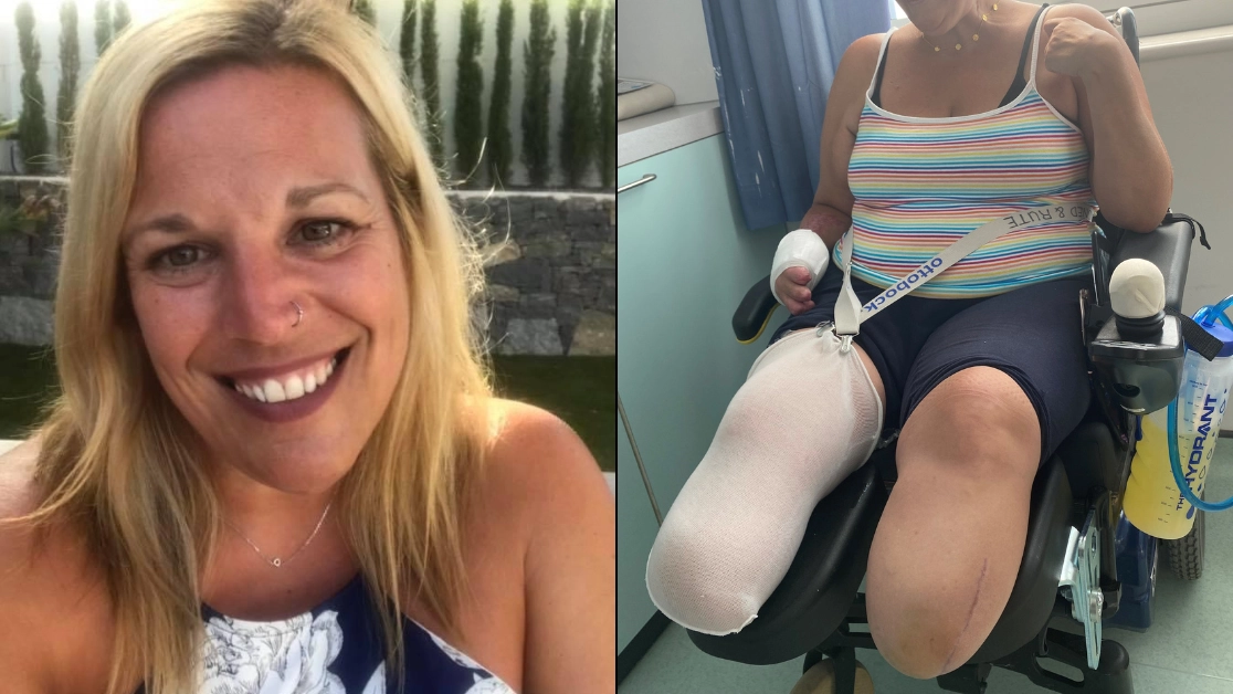 Woman who thought she had winter virus woke up from coma to find out she needed both legs amputating