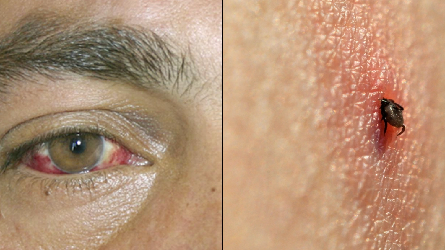 Man Hospitalised With Rare Eye Bleeding Virus That Kills Up To One In Three Patients