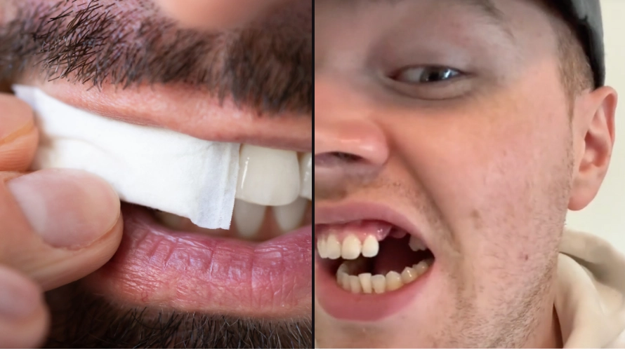 Horrible mouth condition that could arise from using white Snus