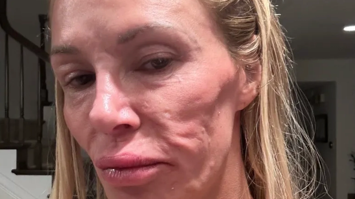 Model Brandi Glanville says breast implants caused facial parasite