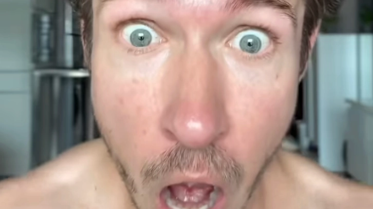 Man shares incredible results of ‘zig zag’ hair transplant pattern after 250 days