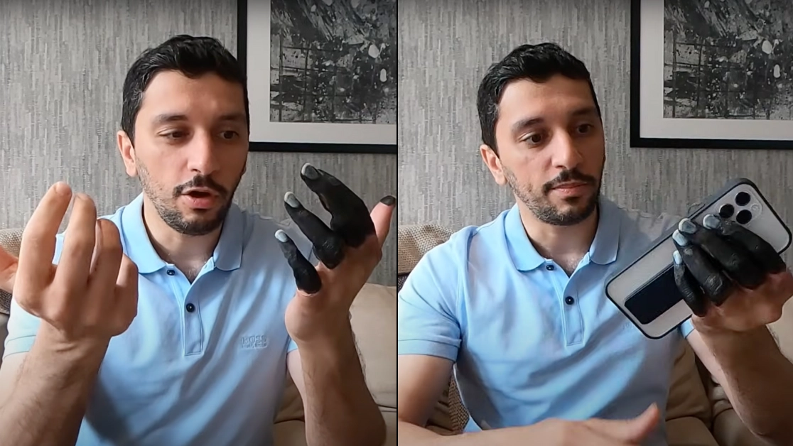 Mountain climber reveals challenges he faced using frostbite hand after hike almost cost him his life
