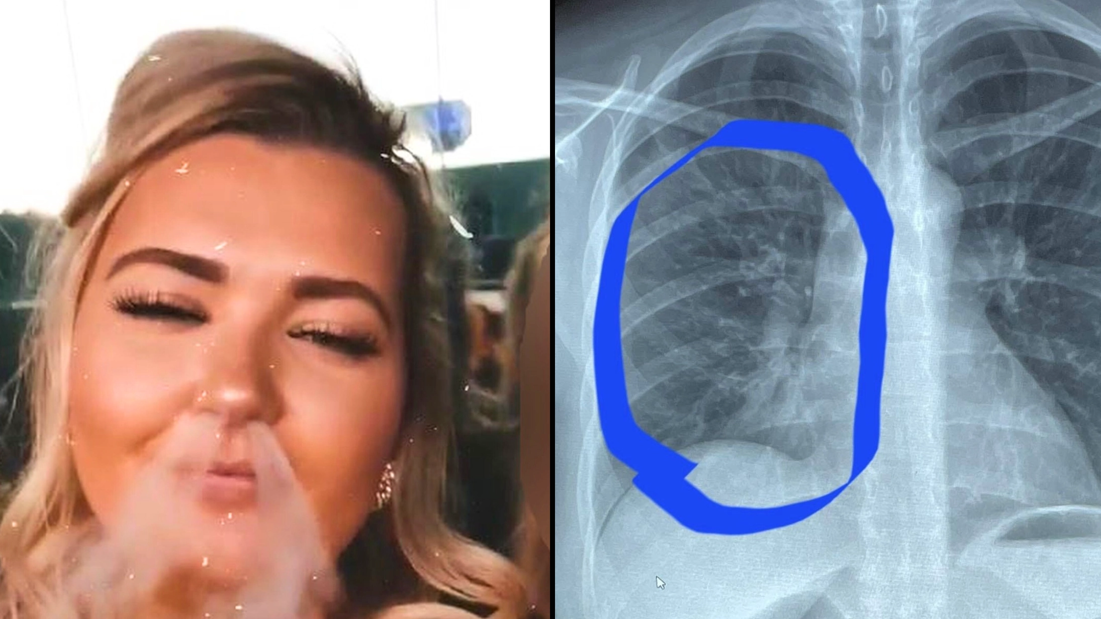 Woman told vaping was 'frying her lungs like chicken' discovers she has lungs of an 80-year-old