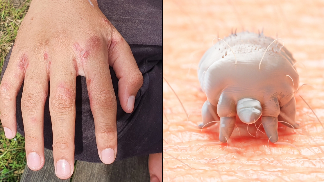 Experts explain who is most likely to get 'tiny red dots' you shouldn't ignore on skin as infections spike in UK