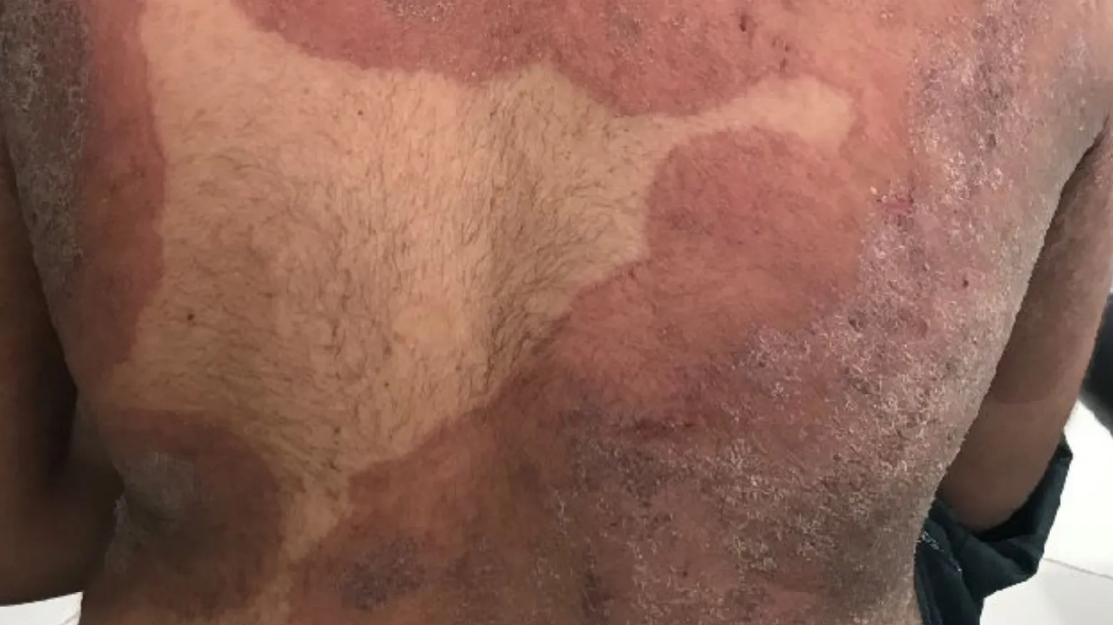 Difference between drug resistant ‘Super fungus’ and eczema as it rapidly spreads across UK