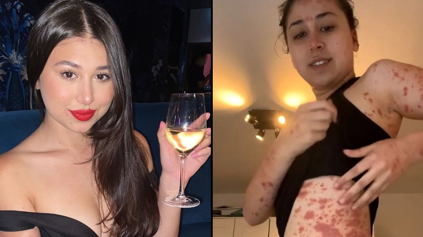 Woman Claims Sharing Vape With Friends Triggered 'Red Raw' Skin Condition