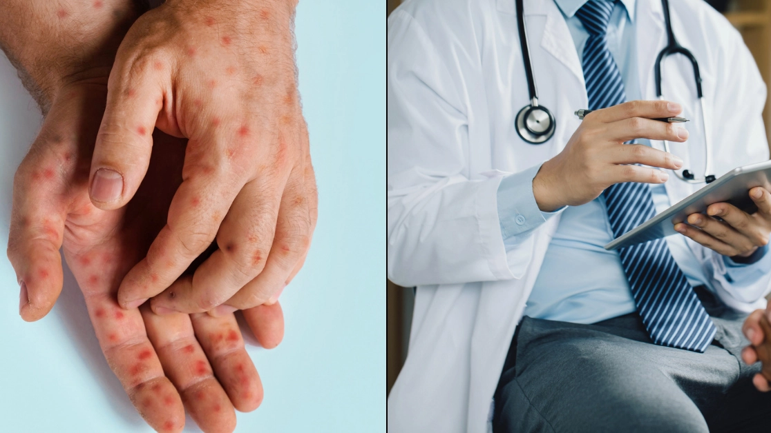 Expert warns deadlier variant of mpox disease is likely already in the country