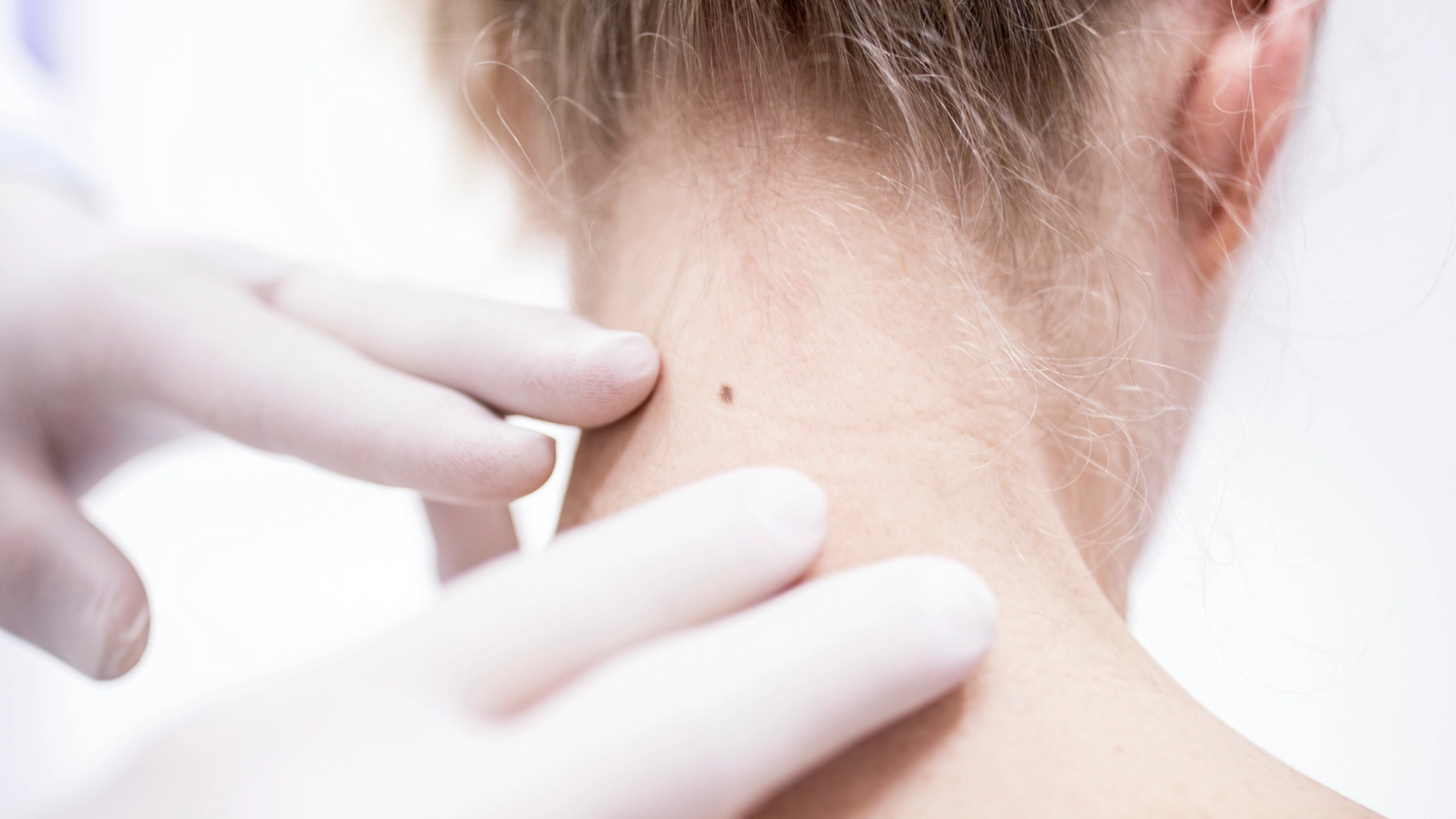 ABCDE rule to check moles for skin cancer after John Cena revealed diagnosis