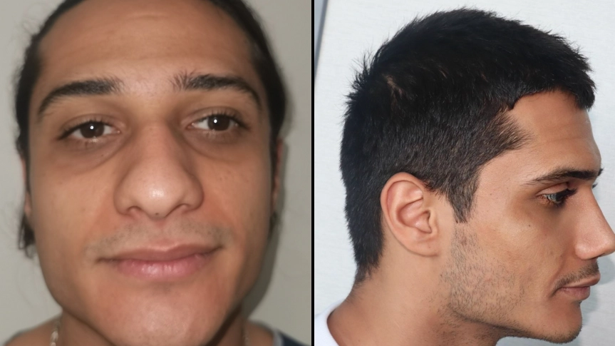 Man will need 'new identity' after Turkish surgery leaves him looking like a completely different person