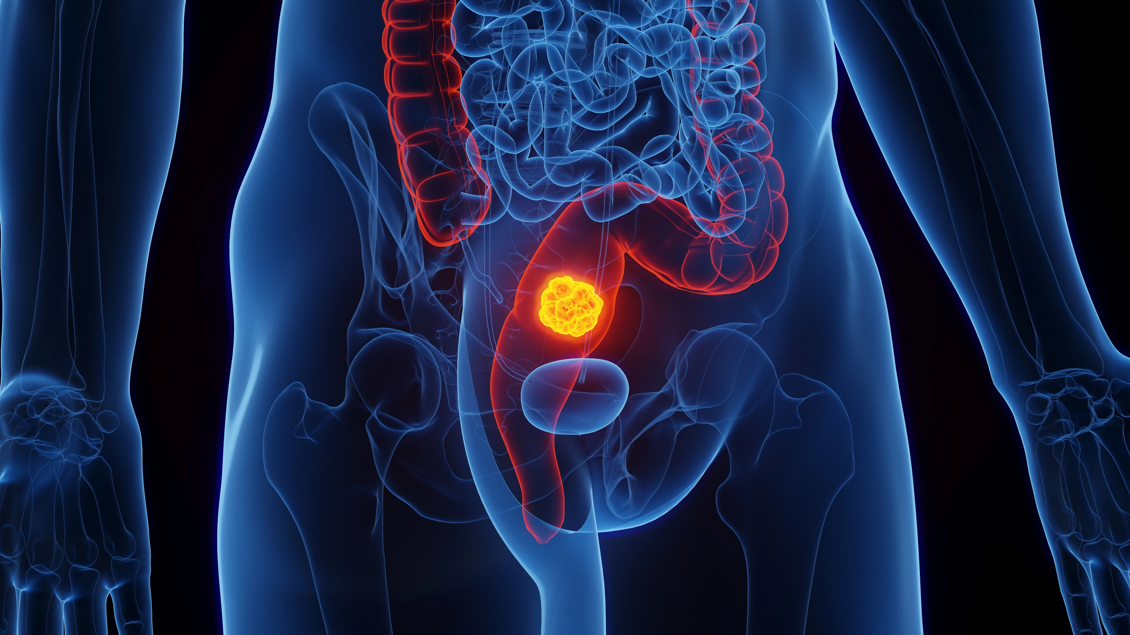 Alarming study shows bowel cancer killing more under-45s with death rates continuing to rise