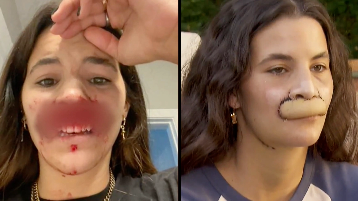 Model whose lip was bitten off by dog shows off transformation after six surgeries