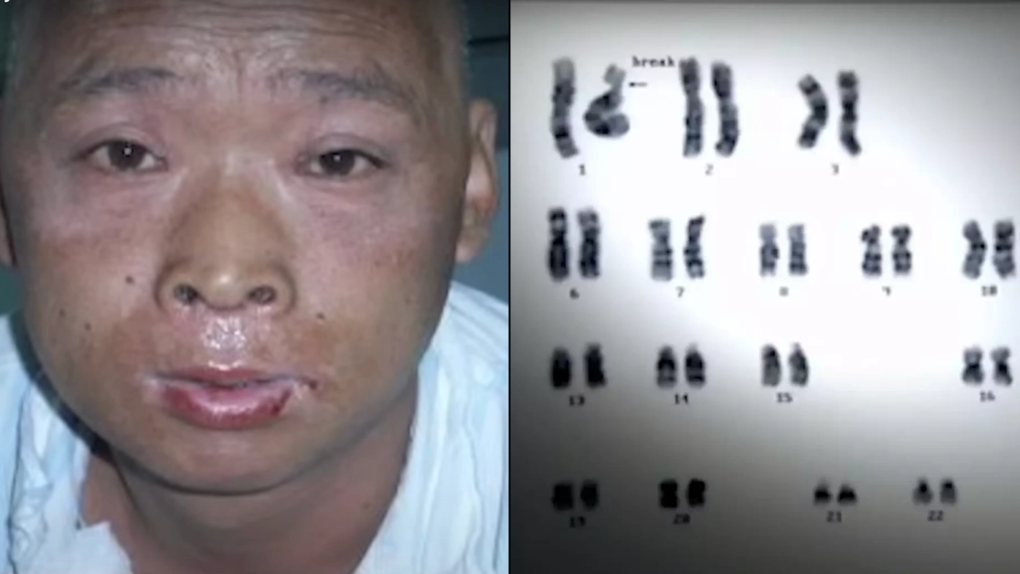 Doctor revealed horrific thing he witnessed as 'radioactive man' suffered one of the most painful deaths ever
