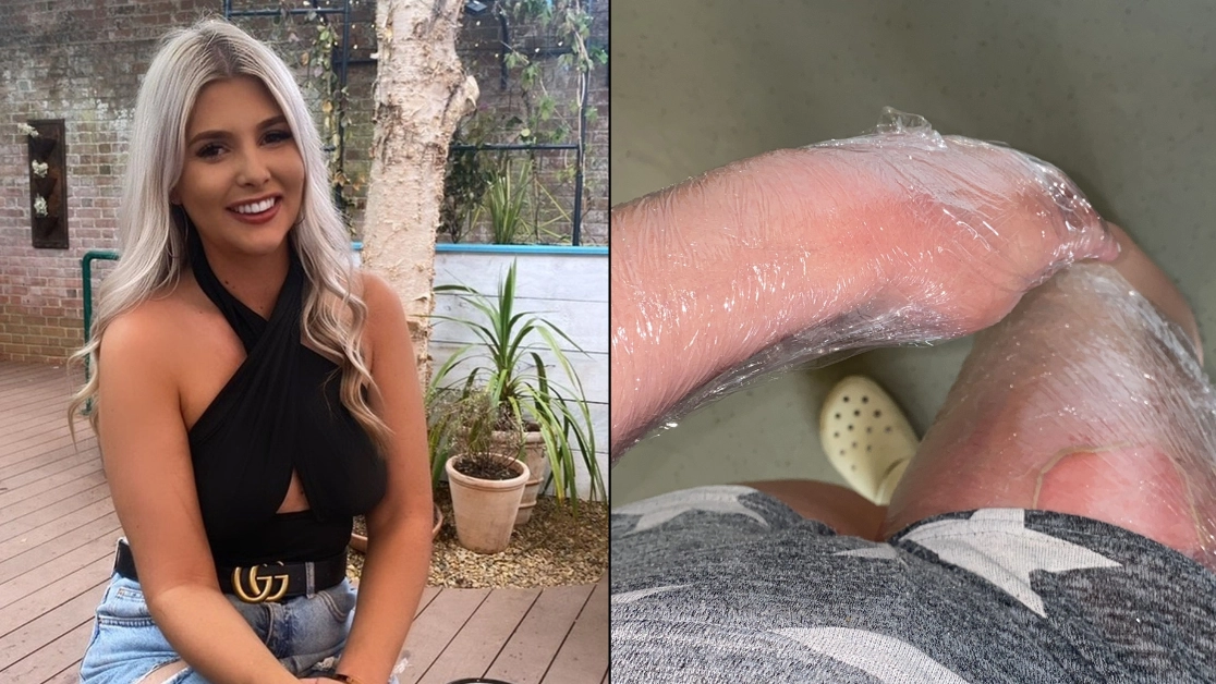 Woman fears legs and privates are scarred for life after not realising hot water bottle was out of date