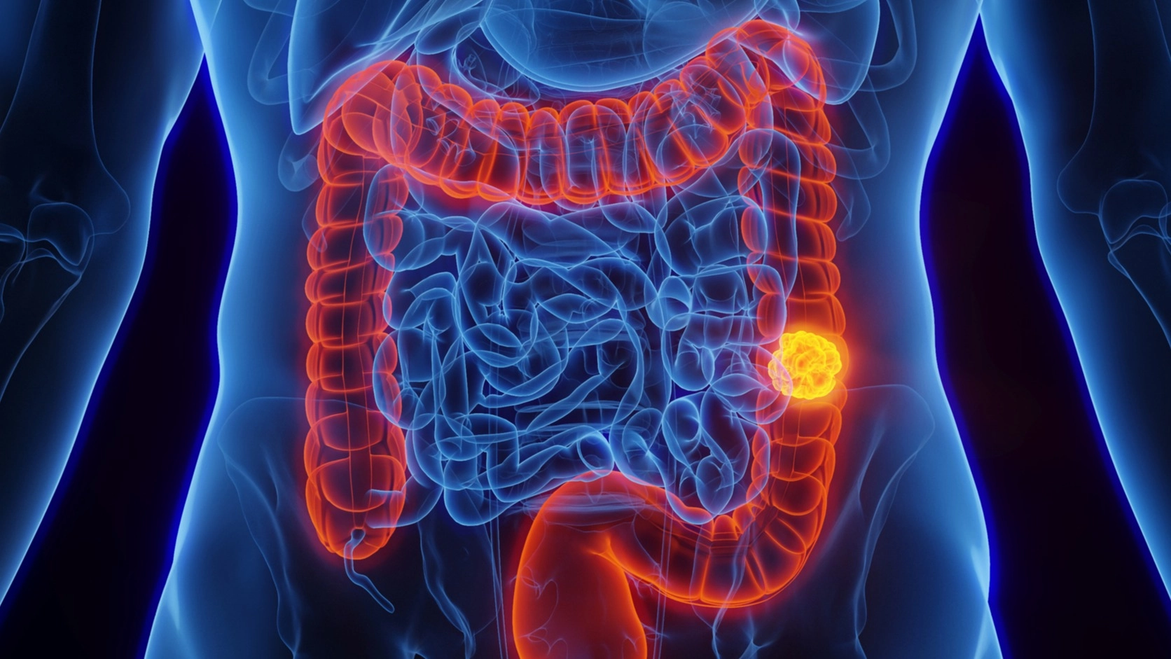 Researchers may have found new cause of colon cancer as cases rise in young people