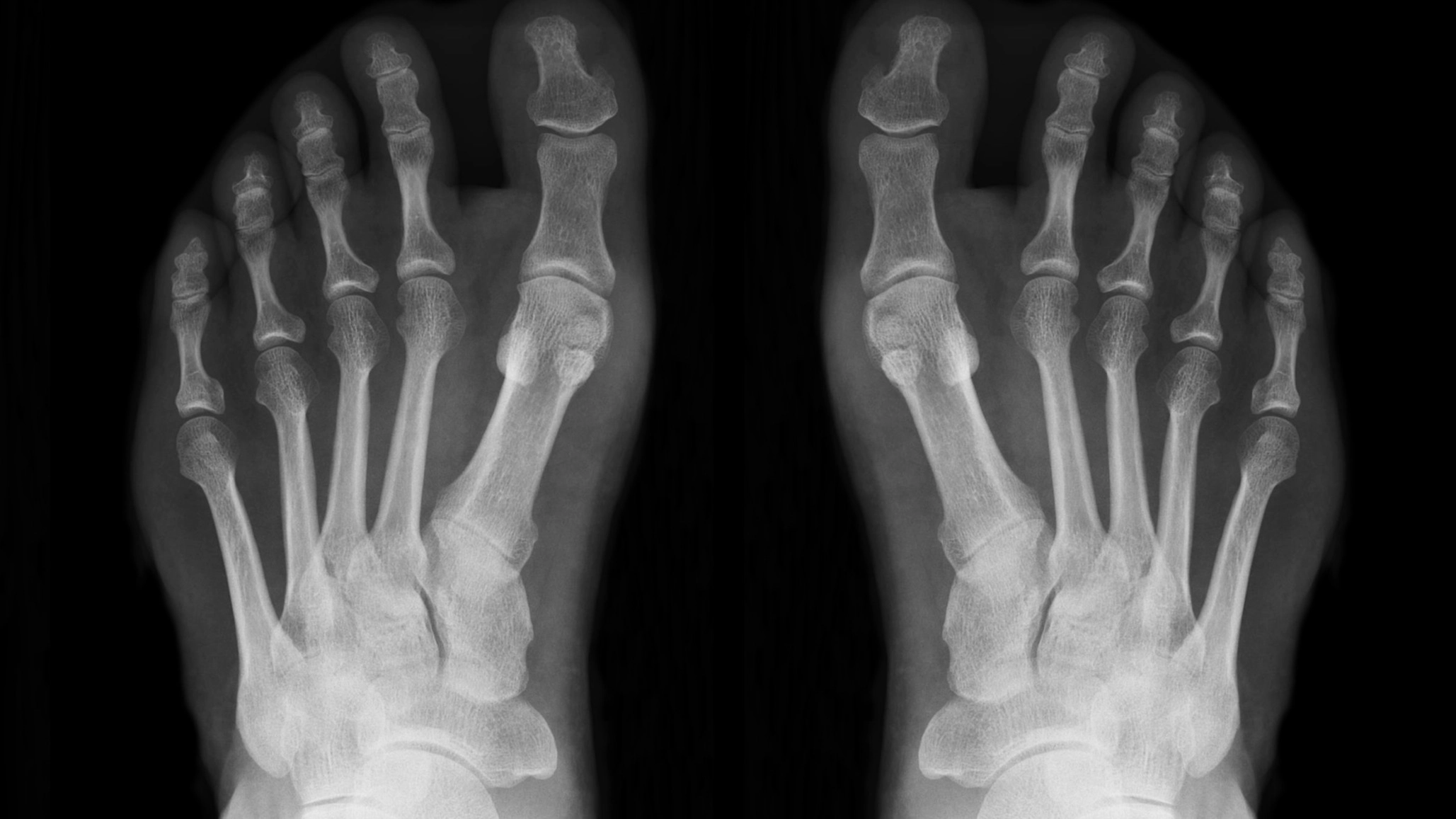 Weird theory explains why you've never broken a bone