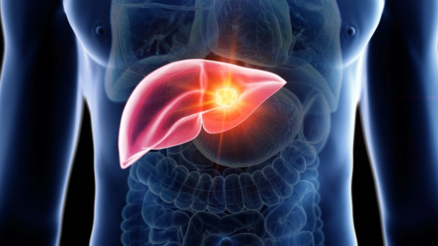 Symptoms of MASLD liver disease as cases predicted to rise to 1.8 billion by 2050