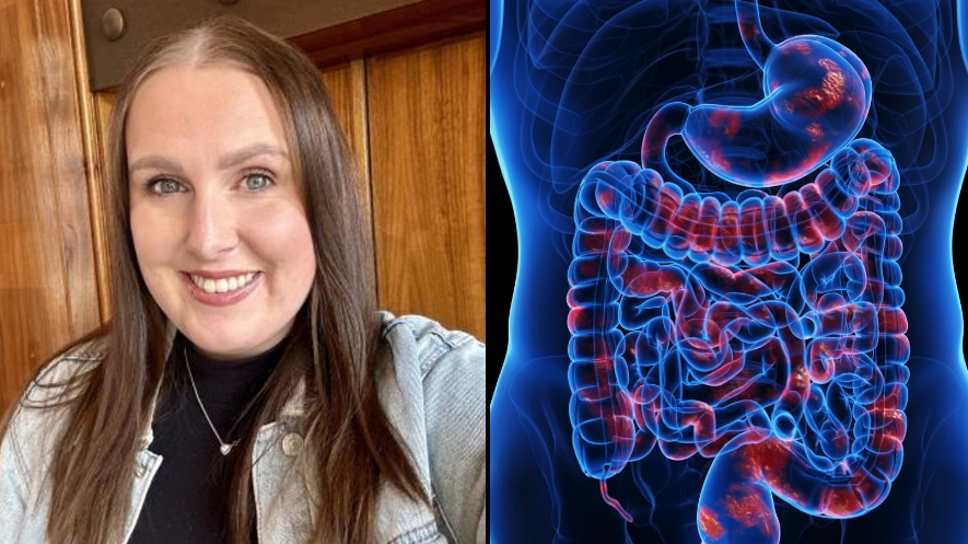 Woman living with inflammatory bowel disease explains 'hardest thing' about having condition