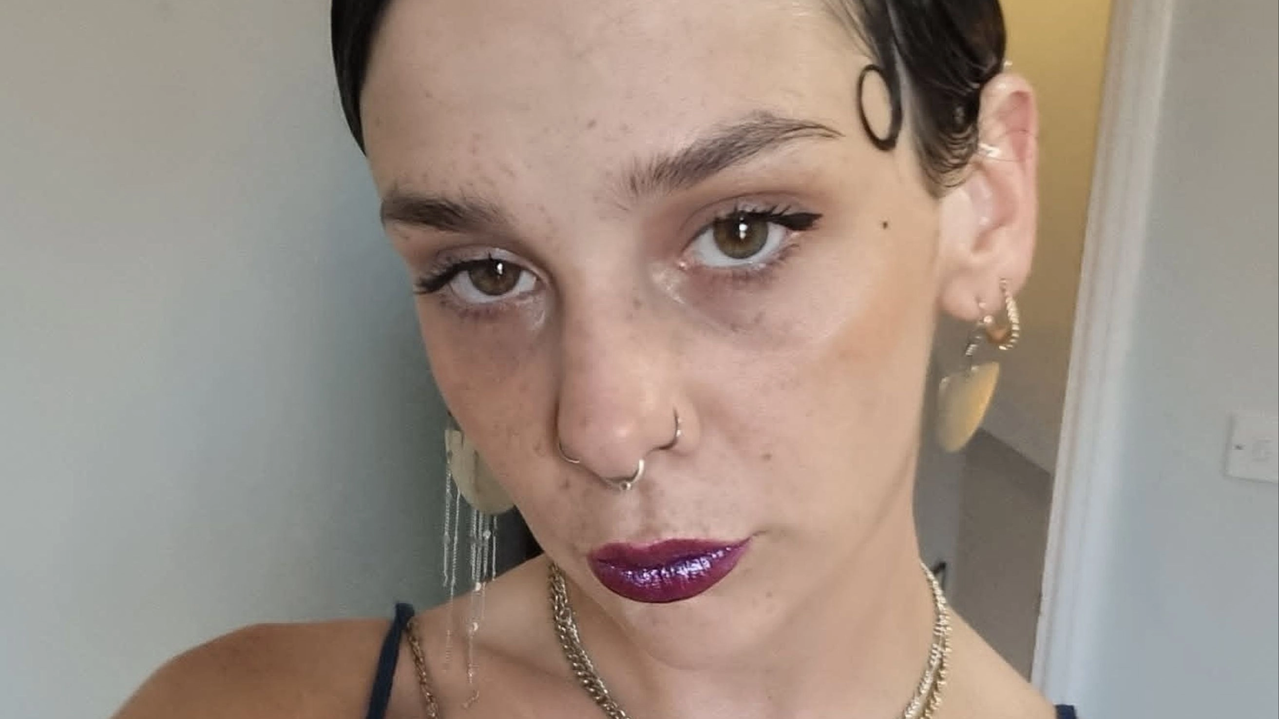 Woman had to have eye removed after struggling to see Beyoncé on TV